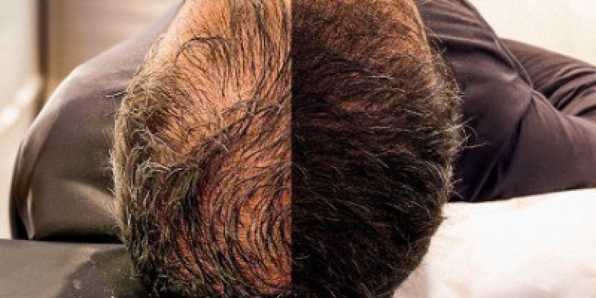 Restore Your Hair and Confidence with Hair Transplants in Islamabad