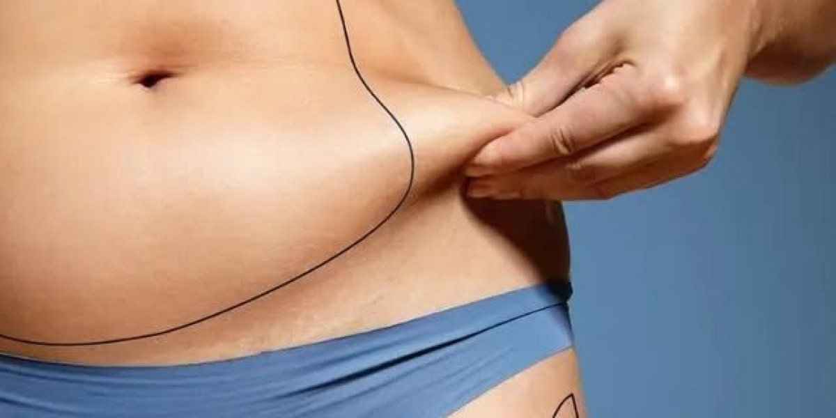 The Cost of Tummy Tuck in Dubai: What to Expect in 2025
