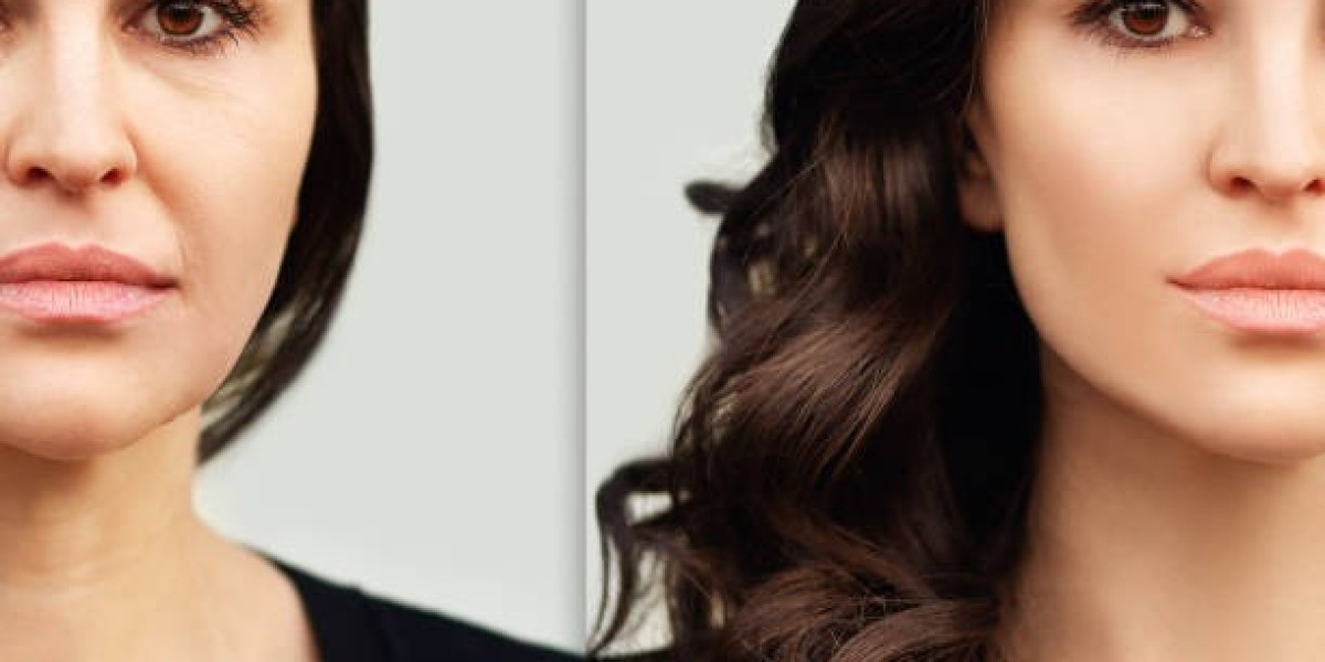 Chemical Peel in Dubai: The Ultimate Guide for Beginners