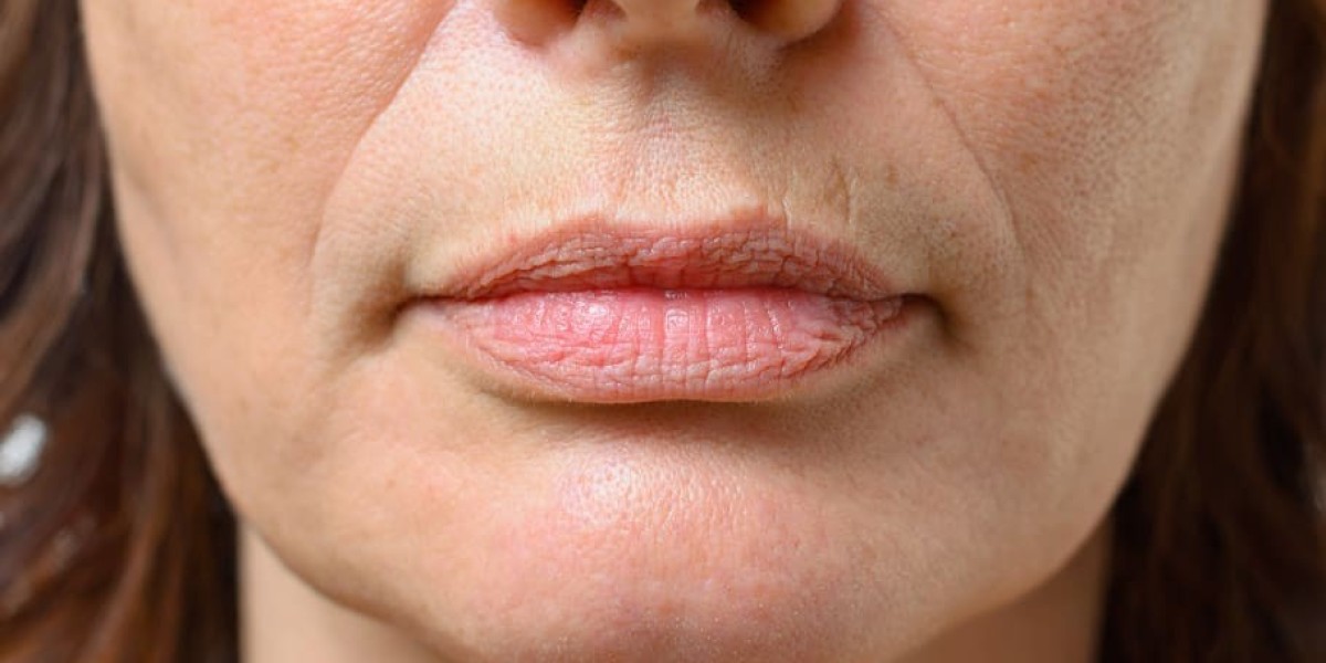 Can Smoker’s Lips Treatments Reduce Fine Lines Around the Mouth?