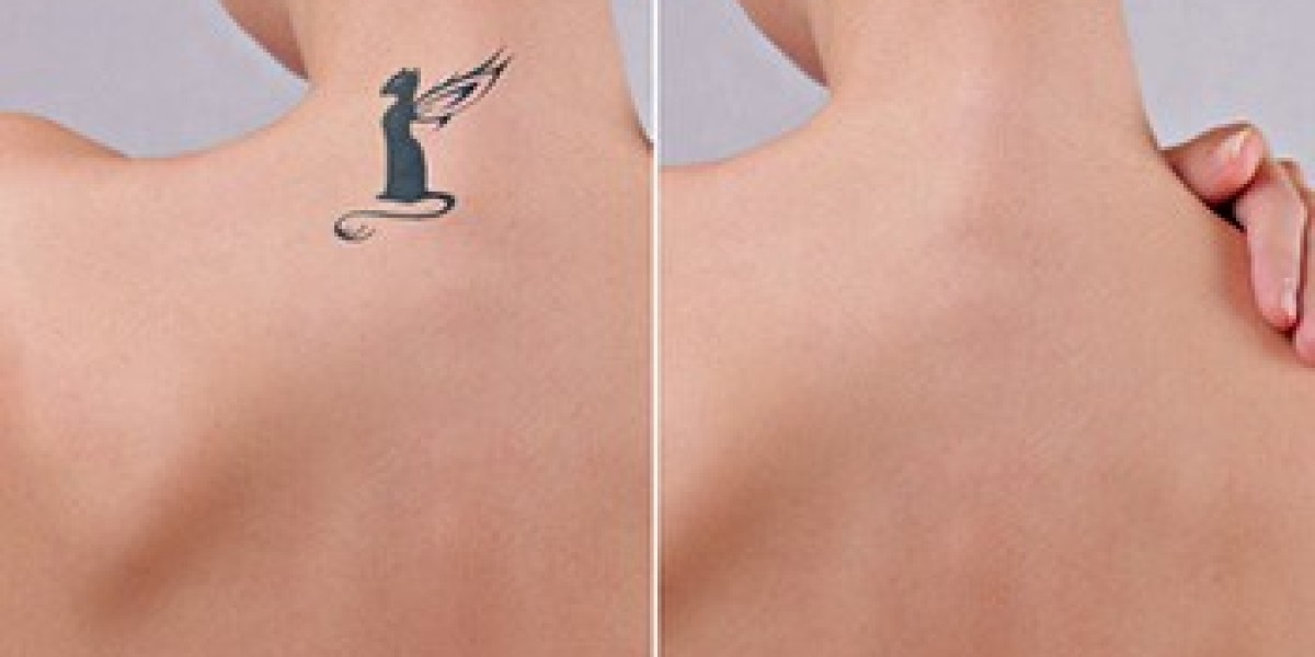 Glamorous Clinic Dubai: Trusted Experts for Laser Tattoo Removal