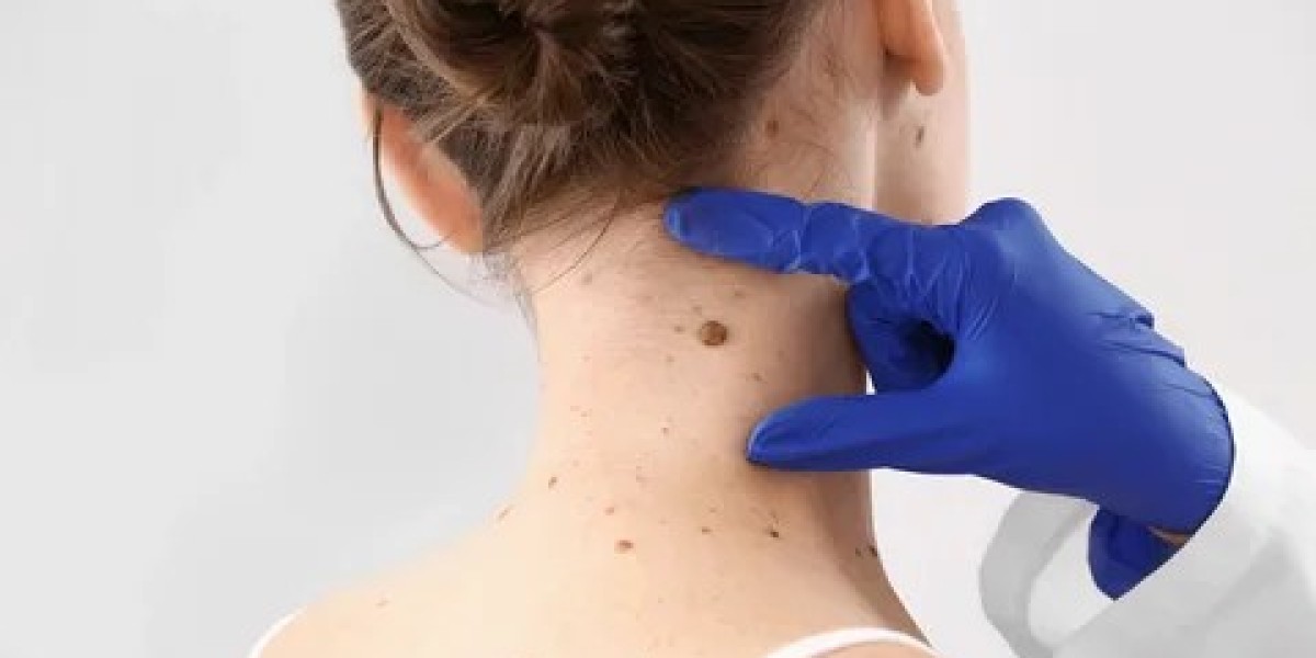 Mole Removal Options for Large Moles in Islamabad