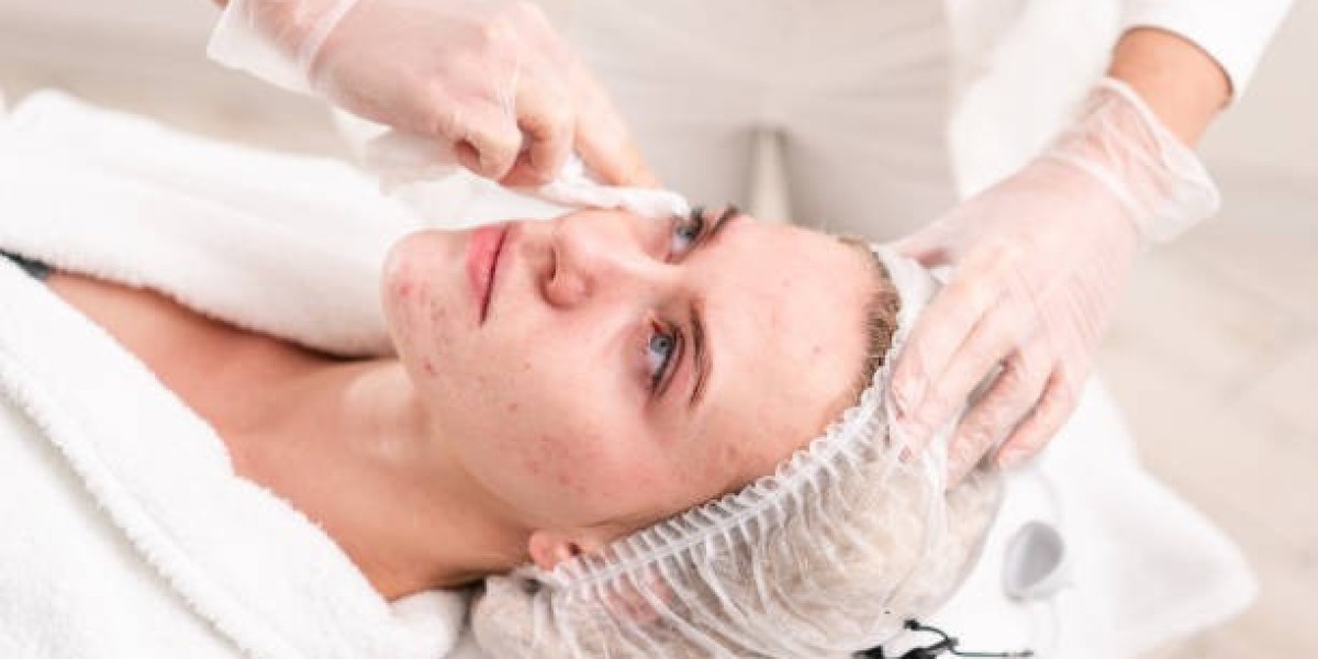 Pimples Treatment Solutions for Acne-Free Confidence