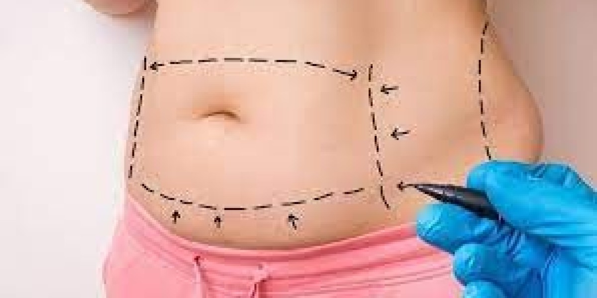 Does a Tummy Tuck Effectively Eliminate Excess Fat in the Belly Area?