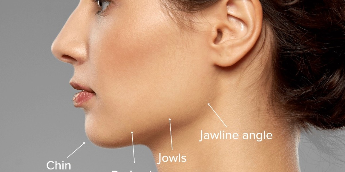 Perfectly Sculpted Jawline with Fillers
