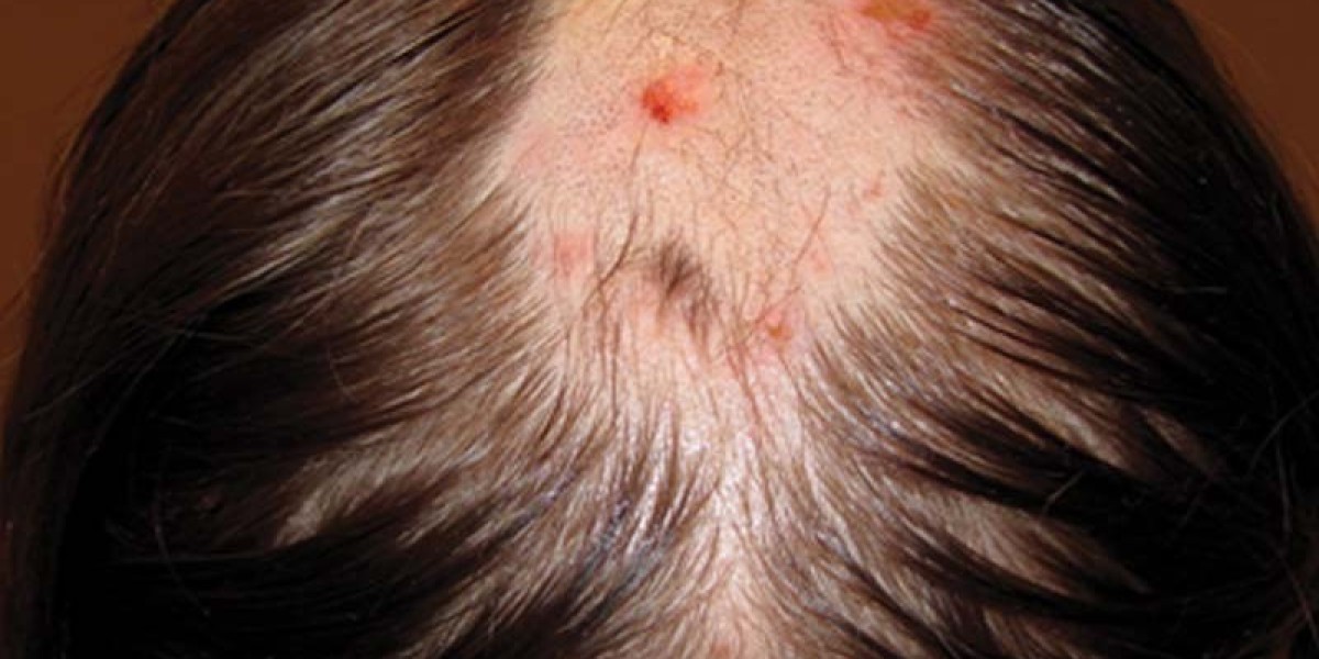 Trichotillomania Cognitive Behavioral Therapy For Lasting Behavioral Change