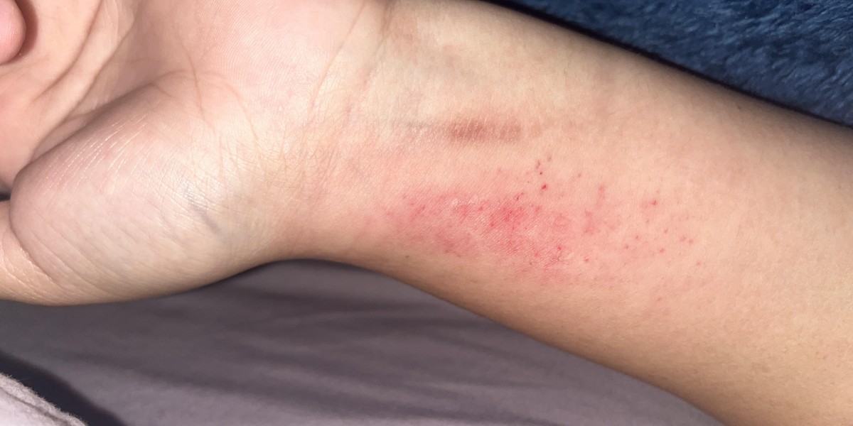 Dermatillomania Treatment, OCD and Dermatillomania: Effective Strategies and Insights