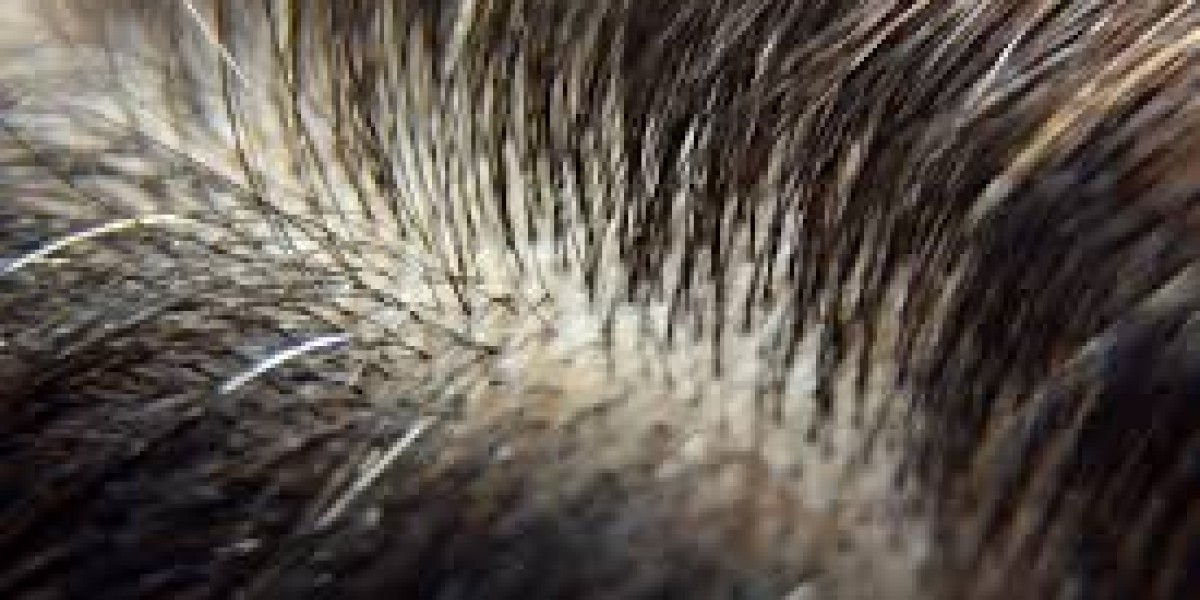 Hair Transplant Market Growth Trends & Forecast to 2033