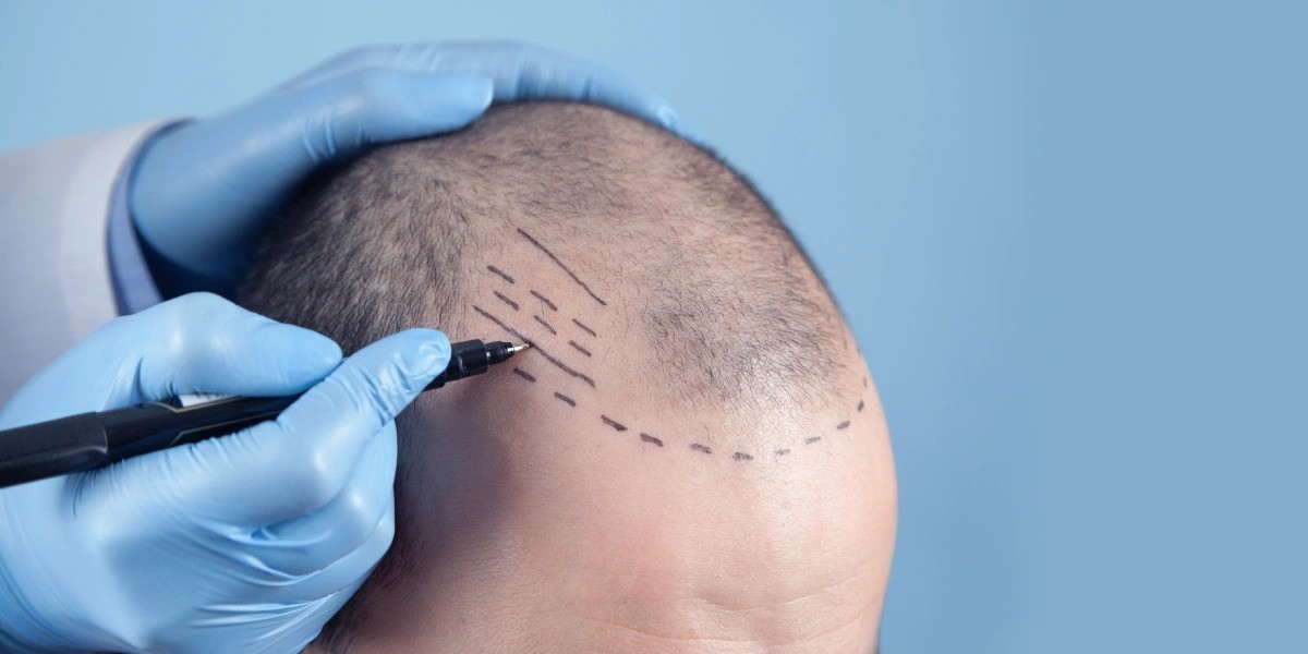 How a Hair Transplant Doctor Designs Your Hairline?