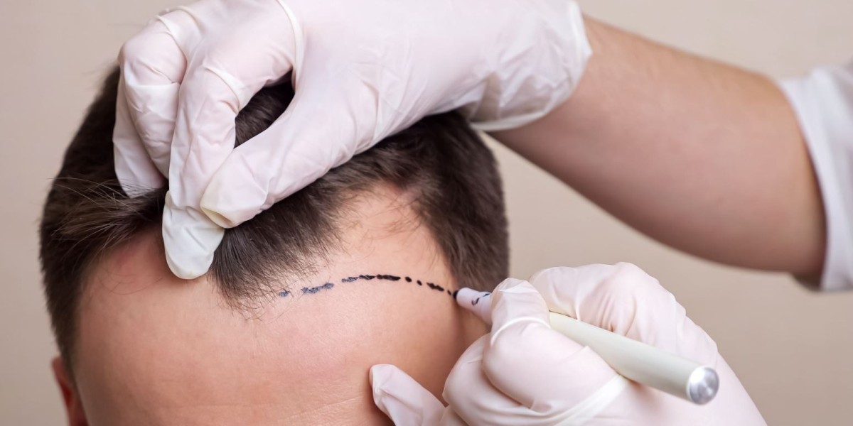 Is Scarless Hair Transplant in Dubai a Pain-Free Option?