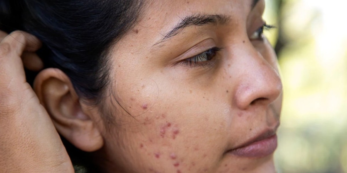 Can Radiance Peel Effectively Reduce Acne Scars?