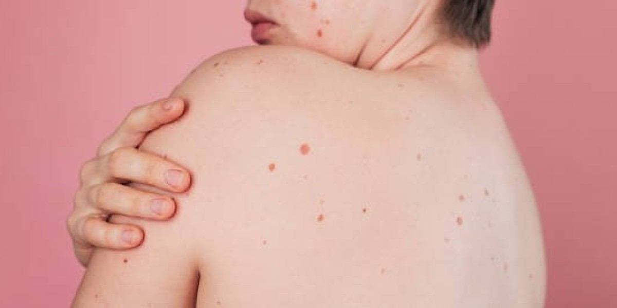Mole Removal Awareness for Better Skin Decisions