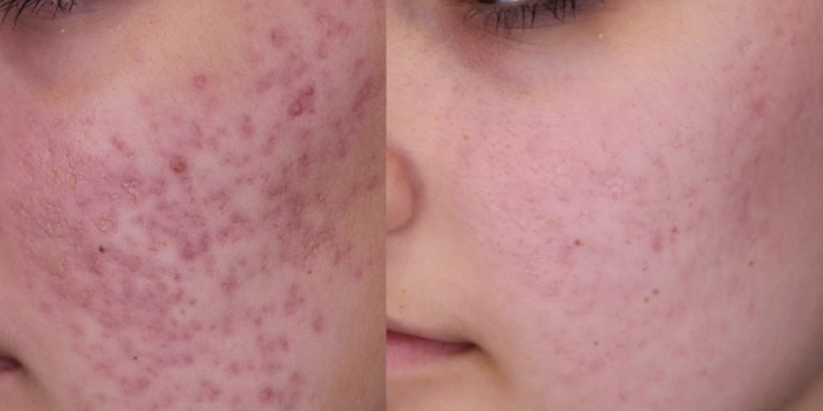 Transform Your Skin with Pico Laser Treatment at Glamorous Clinic Dubai