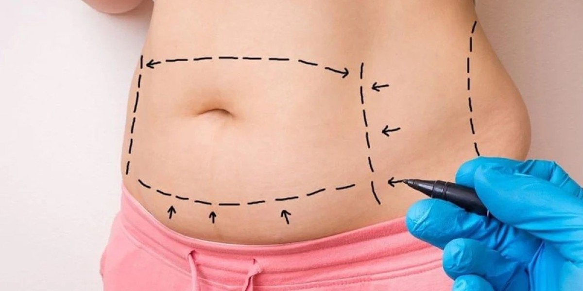 Is a Tummy Tuck the Best Fix for Loose Abdominal Skin?