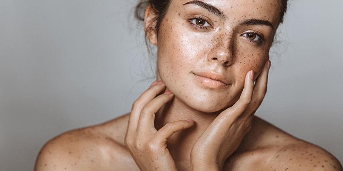 How Hormones Affect Melasma Treatment in Dubai