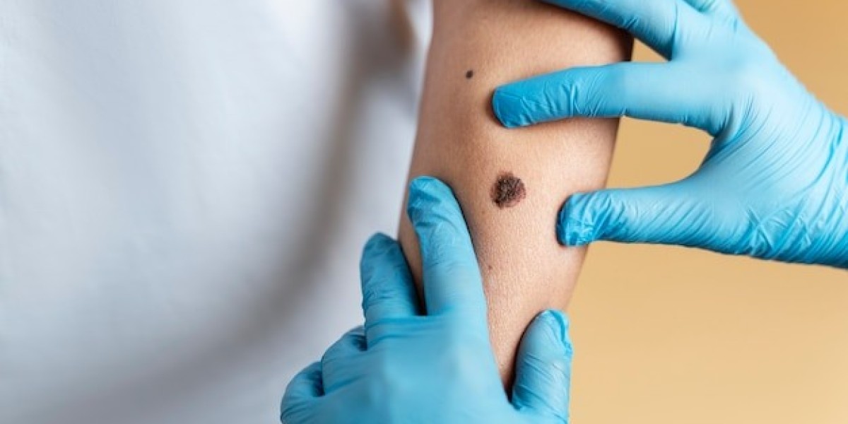 How Does Cryotherapy Remove Warts?