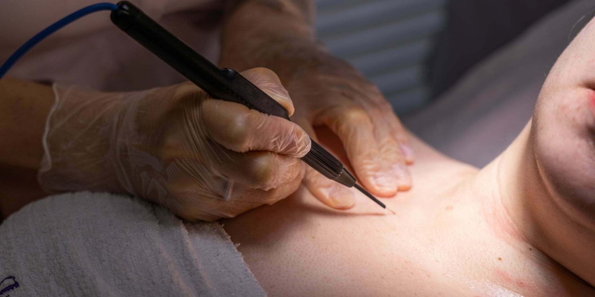 What Are the Common Solutions About Warts Removal Treatments in Dubai?