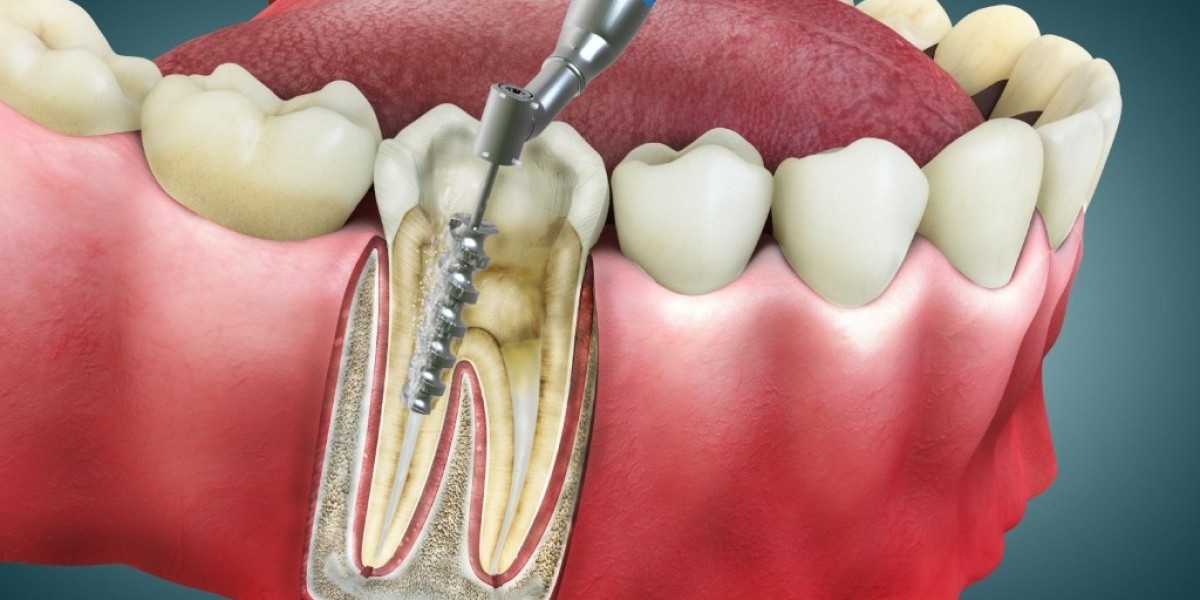 Types of Dental Implants: Which One Is Right for You?