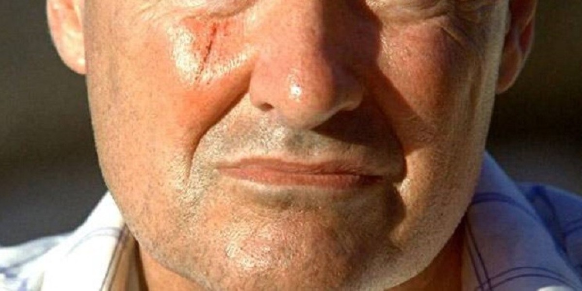 Best Non-Surgical Facial Scar Treatments in Dubai
