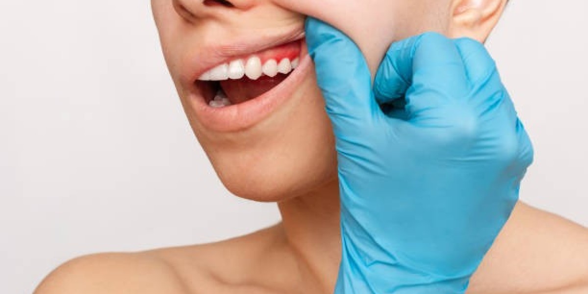What Are the Benefits You Get for the Cost of Gum Recession Treatment?