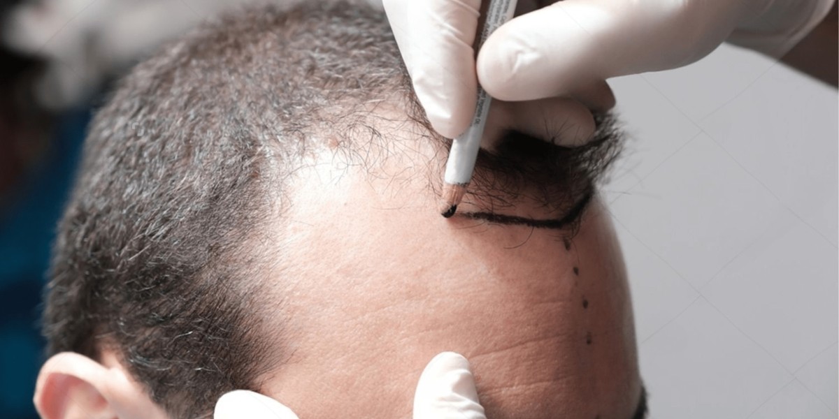 From Sparse to Spectacular: Modern Hair Transplants Explained