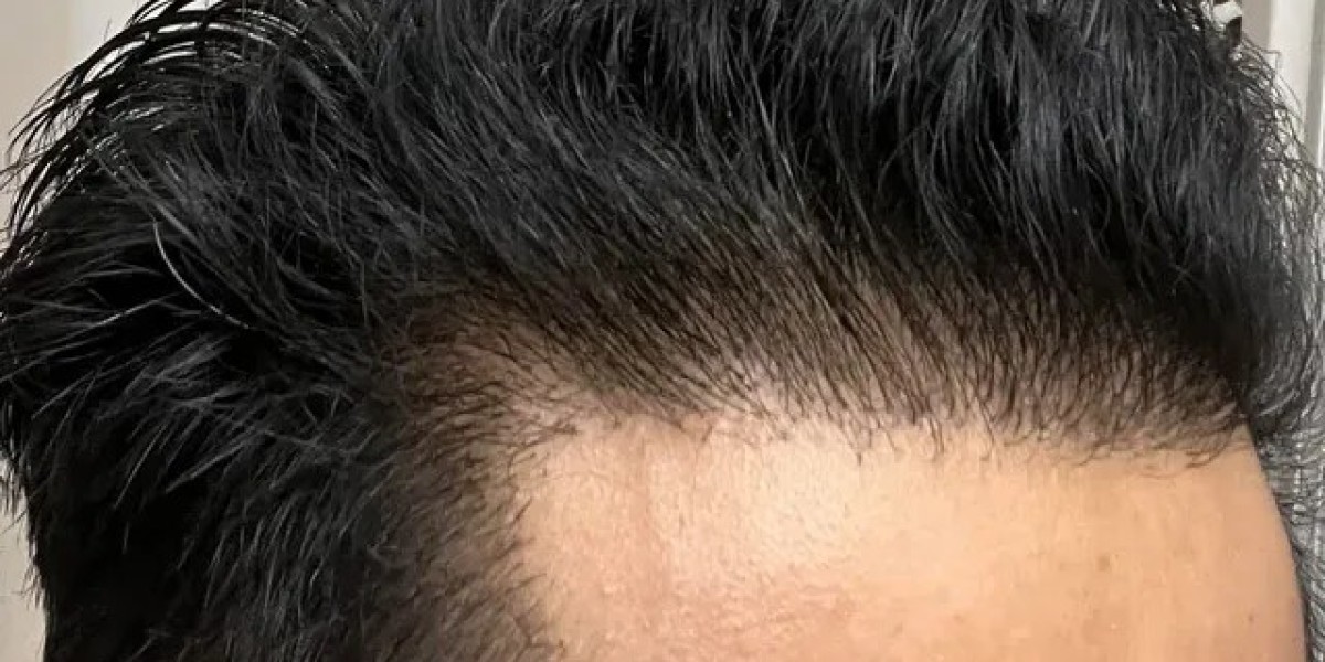 Hair Transplant Cost Hacks to Achieve Effortless Hair Growth