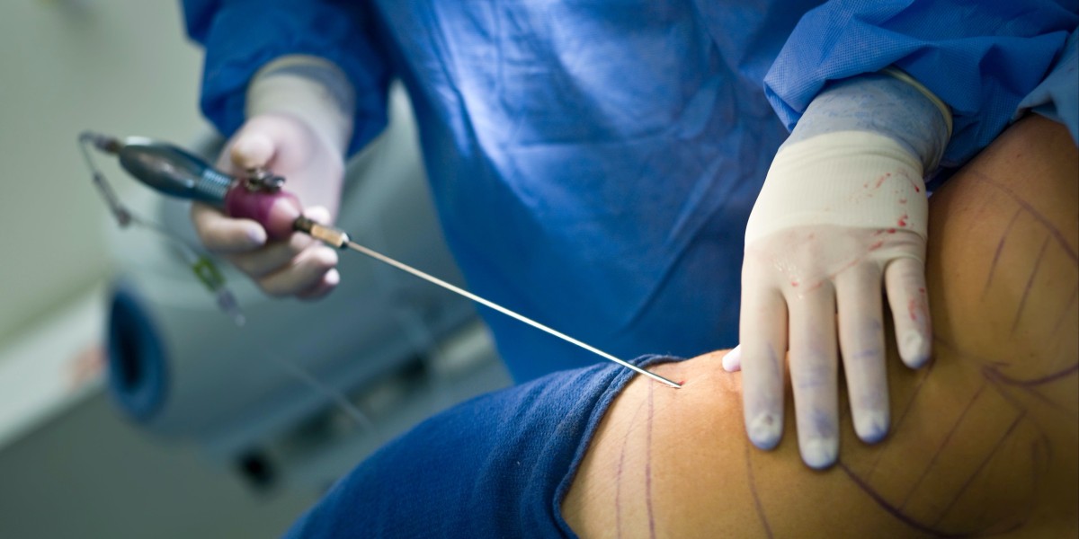 Liposuction vs. Tummy Tuck: Choosing the Right Body Contouring Procedure in 2025