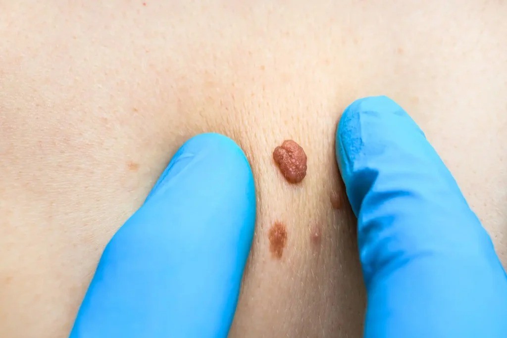 Skin Tag Removal in Dubai
