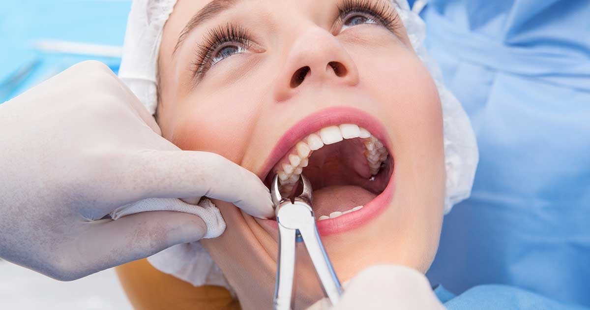 Tooth Removal