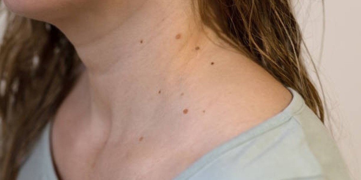 How to Spot Unqualified Providers Offering Mole Removal Services That Aren’t Safe or Effective