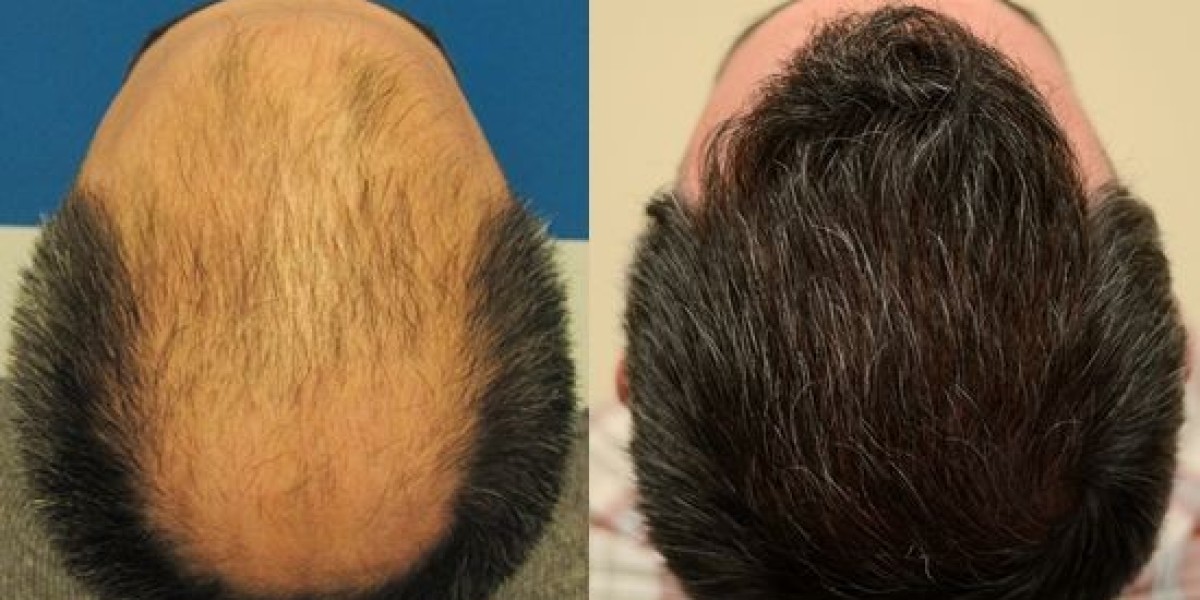 Transform Your Look with Hair Transplant in Islamabad