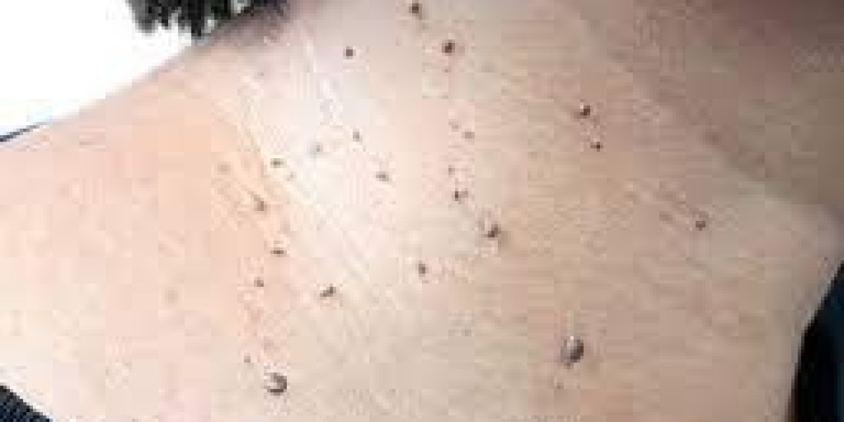 What Is the Average Cost of Skin Tag Removal?