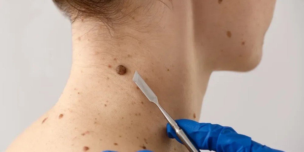 How Is Skin Tag Removal Typically Performed?