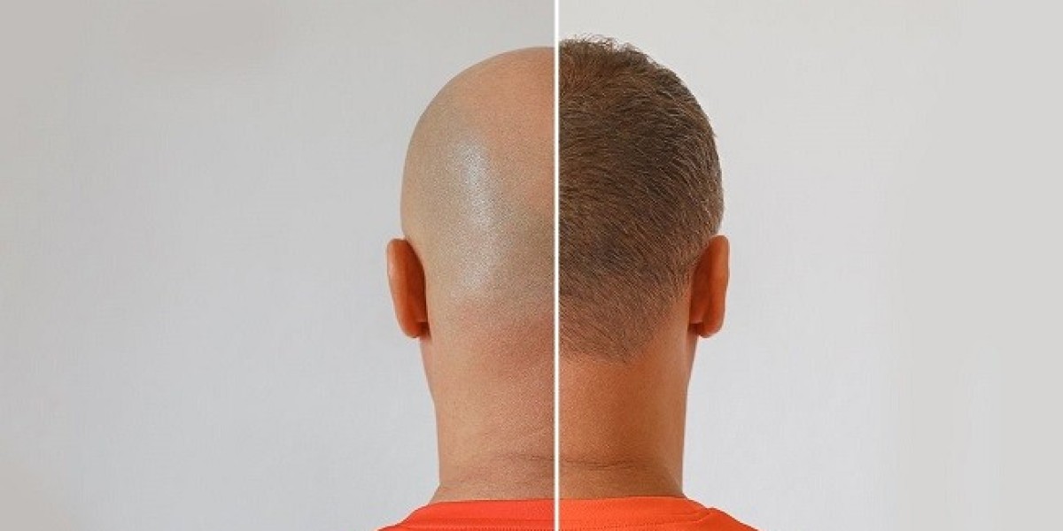 Hair Cloning in Dubai Using Stem Cell Technology