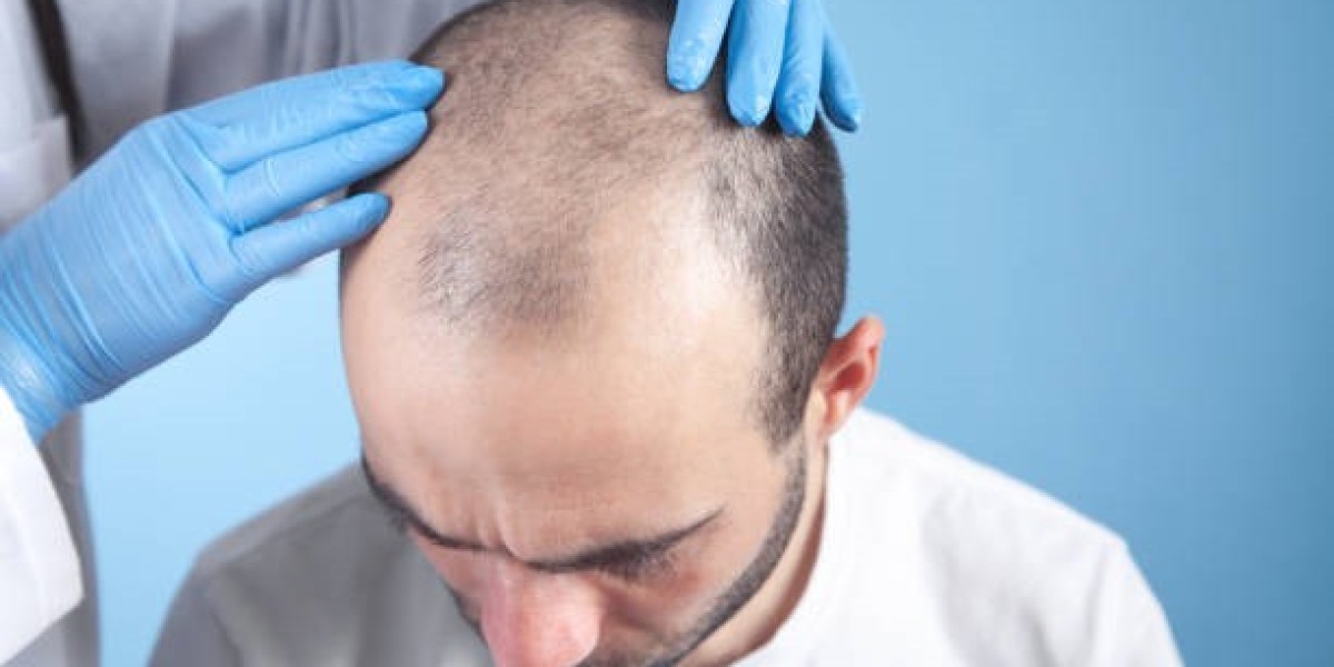 The Role of Stem Cells in Combating Genetic Hair Loss Naturally