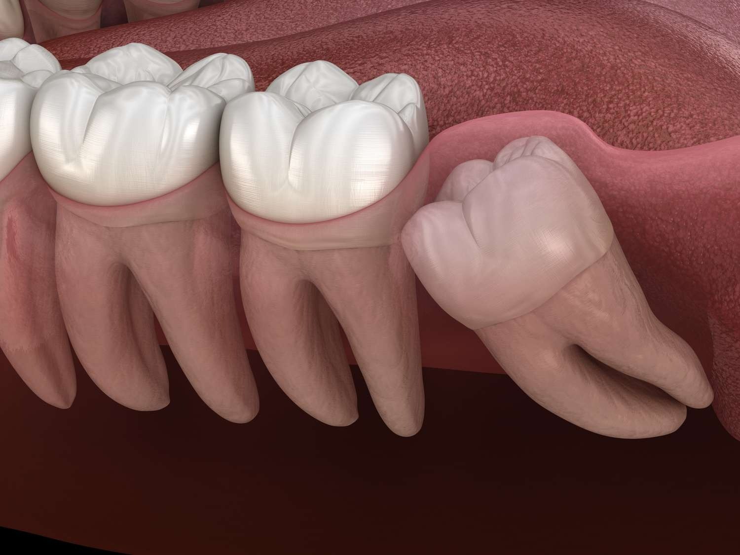 Tooth Removal in Dubai