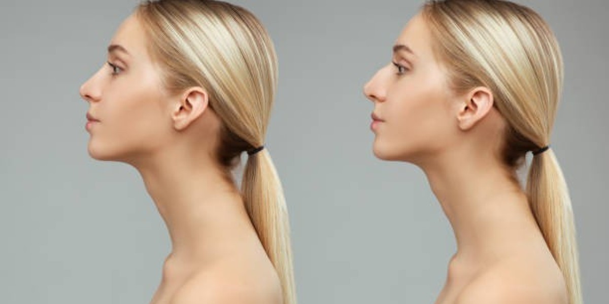 عملية تجميل الأنف في الرياض: ما يجب معرفته