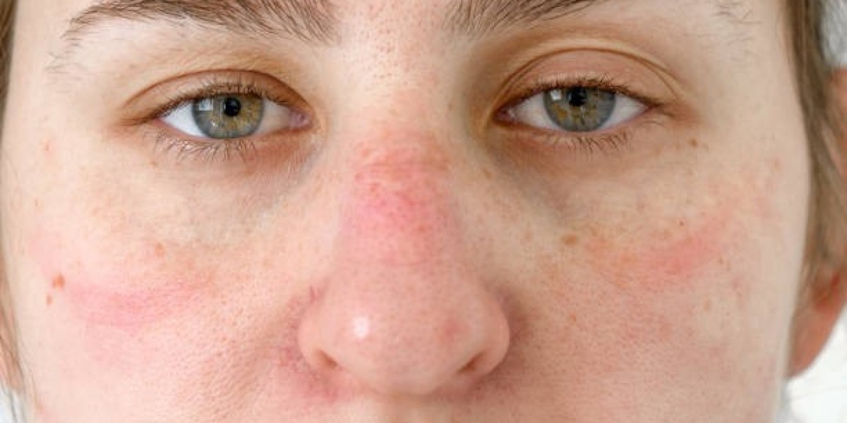 Redness of the Skin Around the Nose from Rosacea: Causes and Care