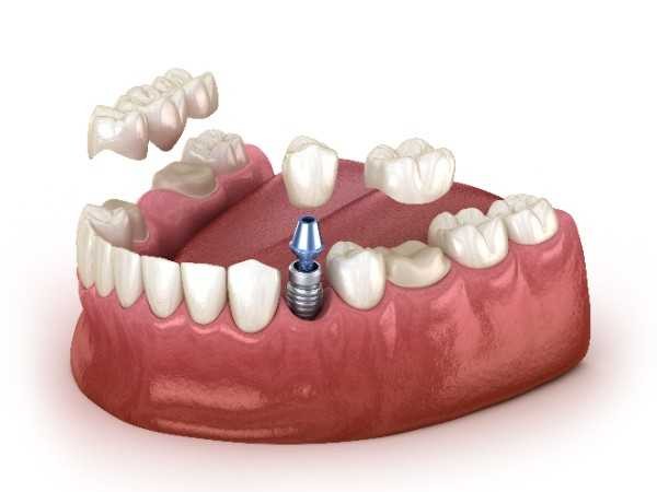 invisalign Bracknell