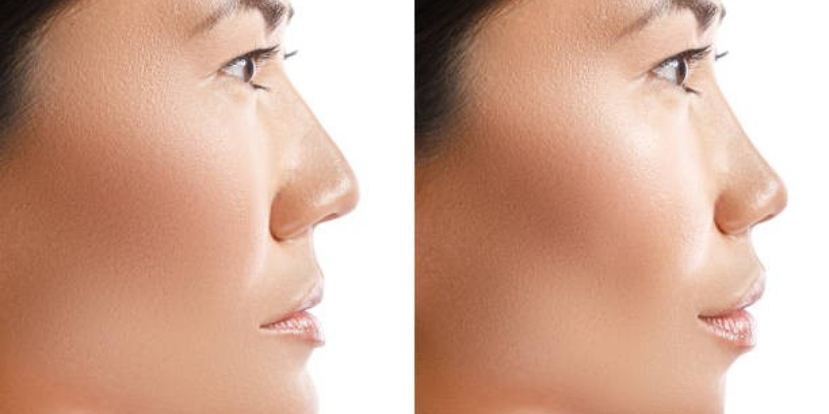 Understanding the Different Types of Rhinoplasty