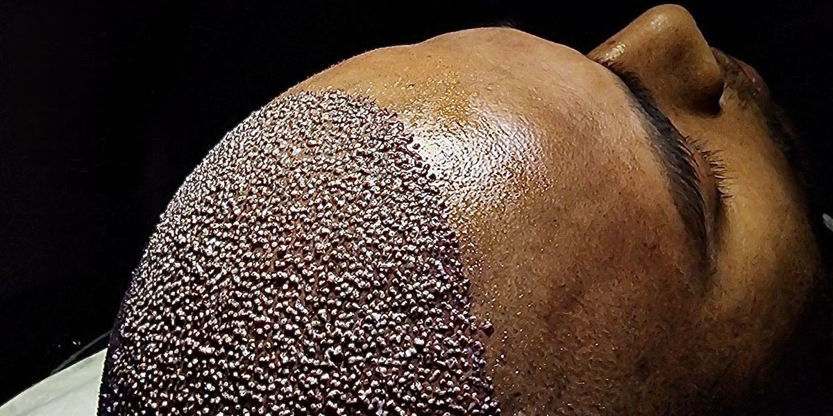 Hair Transplant in Dubai: Expert Tips for Maintaining a Healthy Scalp
