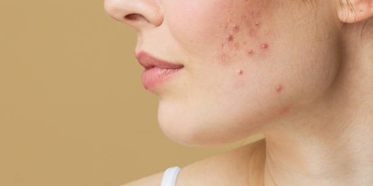 Pimples Treatment to Minimize Scars and Blemishes