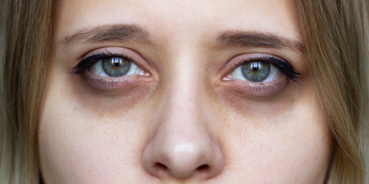 Can a Dermatologist Treat Dark Circles?
