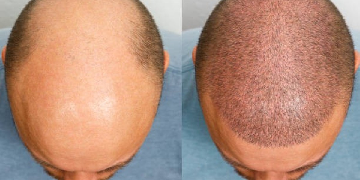 Exploring the Latest Trends in Hair Transplant Care
