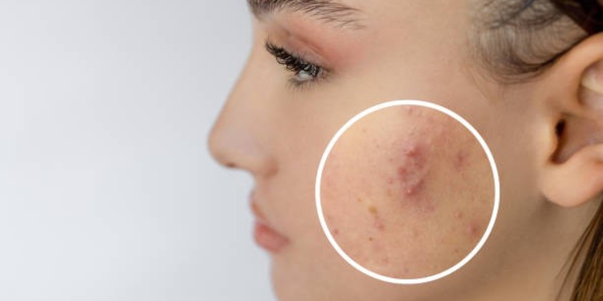 Can Laser Acne Treatment Reduce Redness and Inflammation?