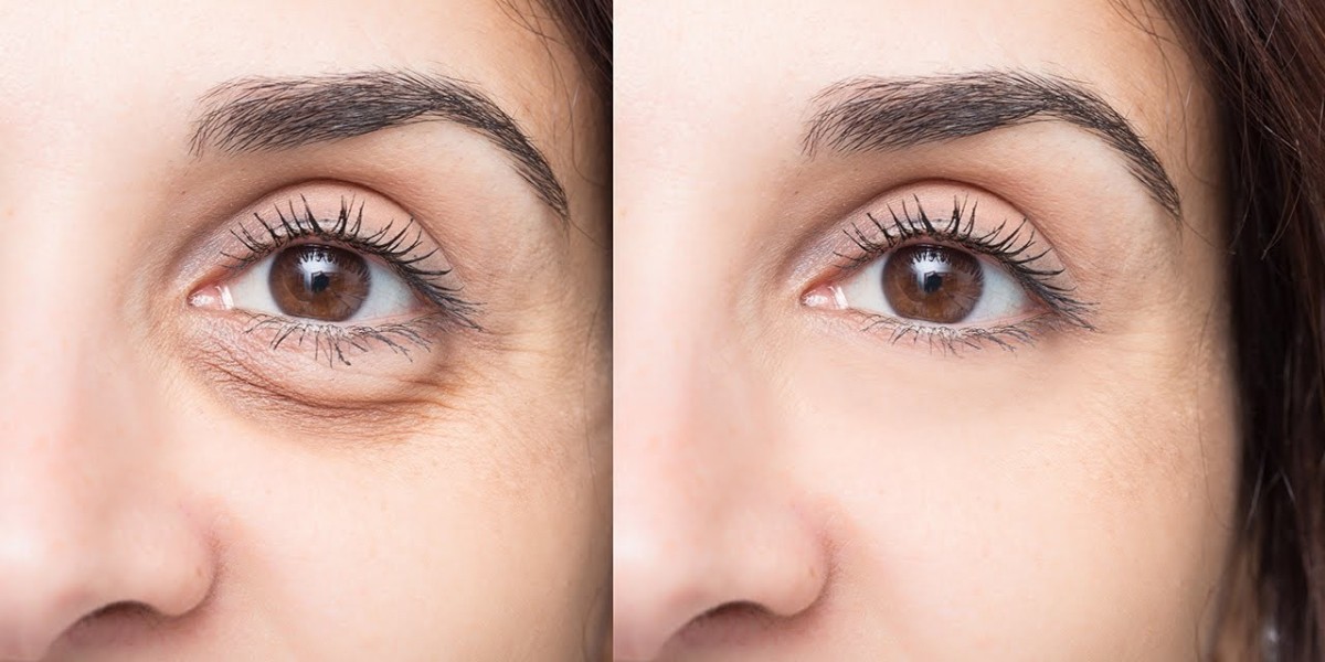 Chemical Peels for Under-Eye Dark Circles in Islamabad
