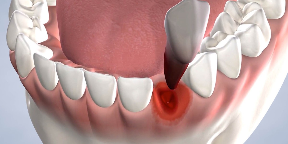 How Long Does Tooth Removal in Dubai Take?