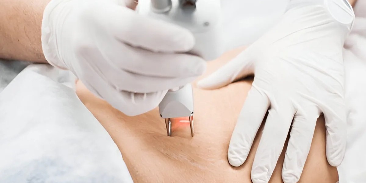 Is Laser Therapy Effective in Minimizing Stretch Marks?