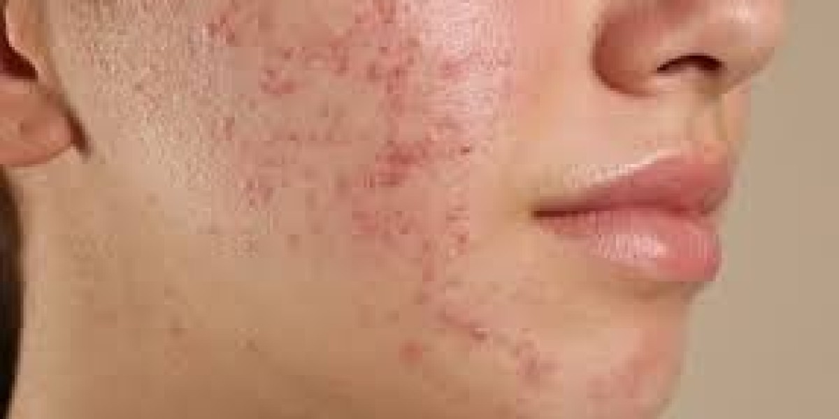 How Does Pimples Treatment Work for Teen Acne?