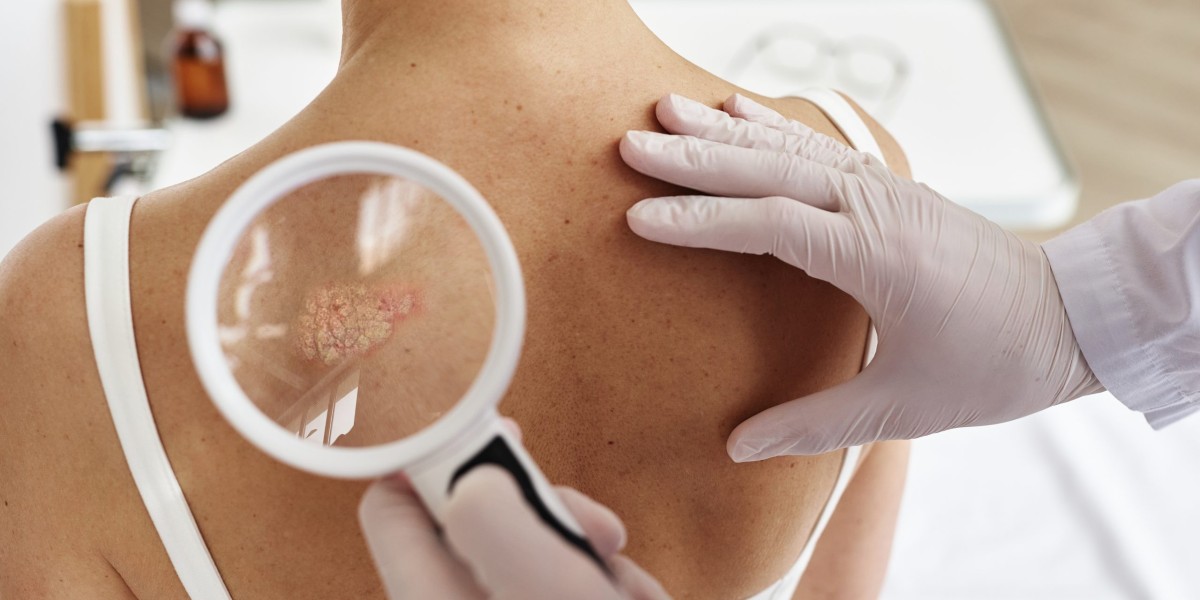 Can Dermoscopy Detect Skin Cancer Early?